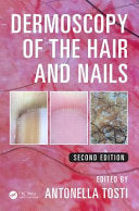 Dermoscopy of the hair and nails.